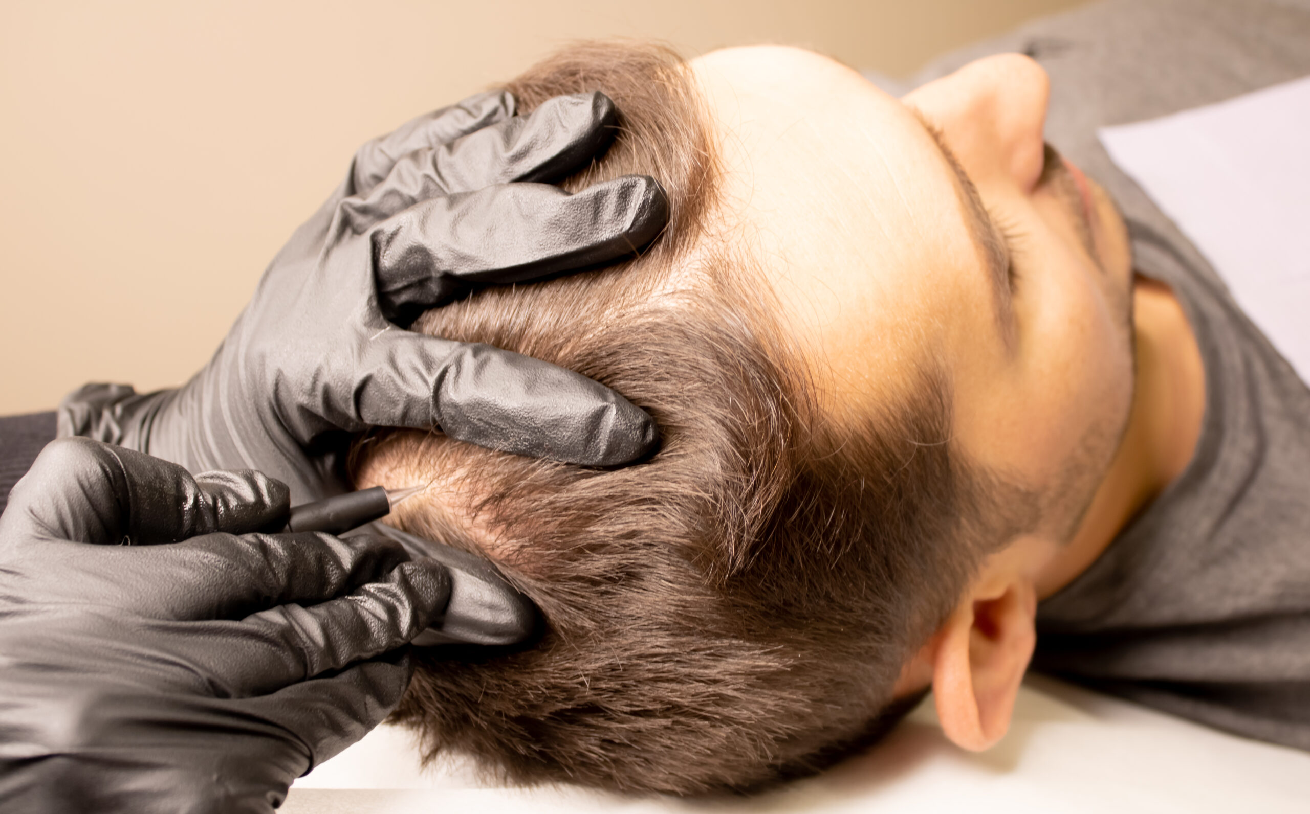 male trichopigmentation service. young man laying on the back on the esthetician table. master hands in a black gloves holding the permanent makeup machine with the needle and touching mans hair.