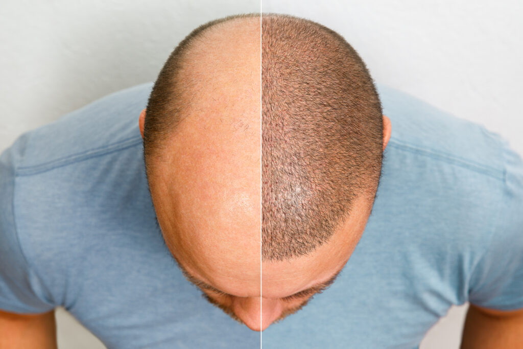 the head of a balding man before and after hair transplant surgery. a man losing his hair has become shaggy. an advertising poster for a hair transplant clinic. treatment of baldness.